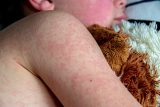 Česko má desítky tisíc dětí neočkovaných proti spalničkám. Léčba neexistuje, lékaři mírní příznaky