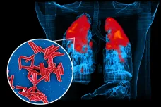 Tuberkulózy bylo loni nejvíc od začátku sledování. Zemřelo na ni víc lidí než na covid